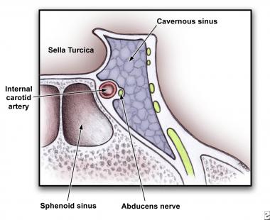 Рисунок 2. Анатомия поперечного сечения кавернозного синуса, показывающая близость к черепным нервам и клиновидной пазухе.