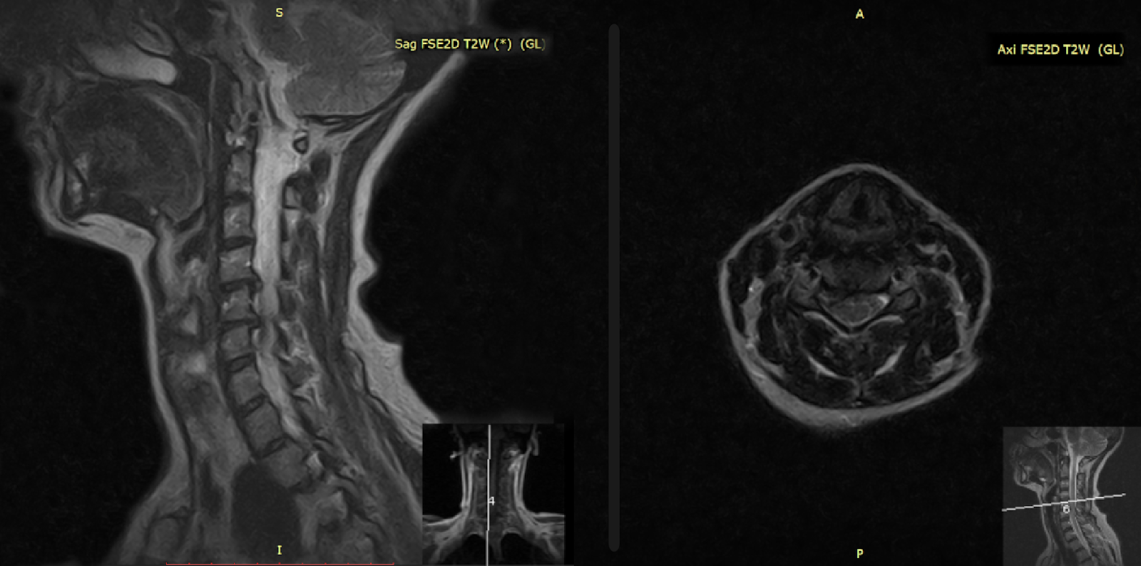 Рисунок 2. Пациентка Ю. 48 лет — сочетание мигрени без ауры и цервикогенной головной боли