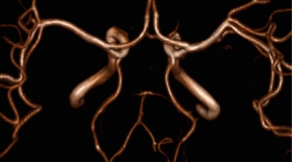 Эндоваскулярная терапия инсульта вследствие окклюзии основной артерии. Исследование BASICS 