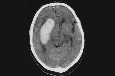 Рисунок 1. КТ головного мозга у больного геморрагическим инсультом