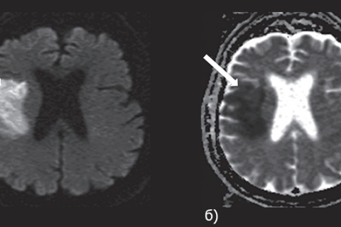 Рисунок 7. МРТ головного мозга в DWI — (а) и ADC — (б) режимах. Стрелкой указана зона ишемических изменений в правом полушарии головного мозга