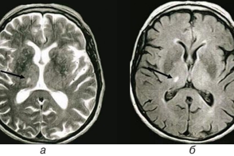 Рисунок 8. Лакунарный инсульт (постишемический очаг в базальных ядрах справа). МРТ головного мозга в режиме FLAIR