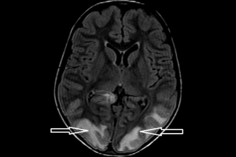 Рисунок 9. Задняя обратимая энцефалопатия (PRES-синдром). Вазогенный отек в теменно-затылочных долях