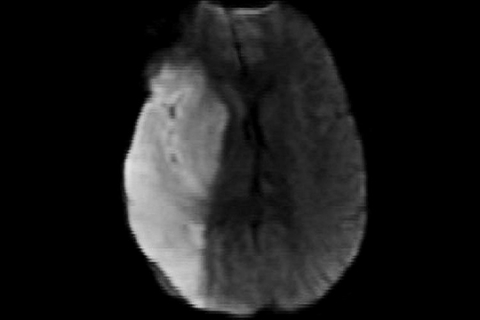 Рисунок 10. МРТ головного мозга в DWI-режиме. Стрелкой указана зона ишемических изменений в правом полушарии головного мозга