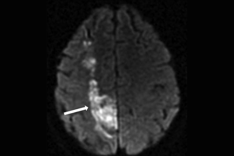 Рисунок 11. МРТ головного мозга в DWI-режиме Инфаркт головного мозга на стыке бассейнов передней и средней мозговых артерий