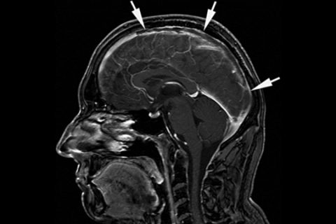 Рисунок 12а. МРТ головного мозга: тромбоз сагитального синуса.