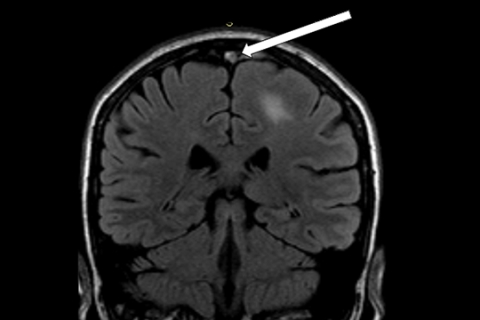 Рисунок 12б. При МРТ головного мозга: признаки тромбоза сагиттального синуса с развитием венозного инфаркта левой теменной доли