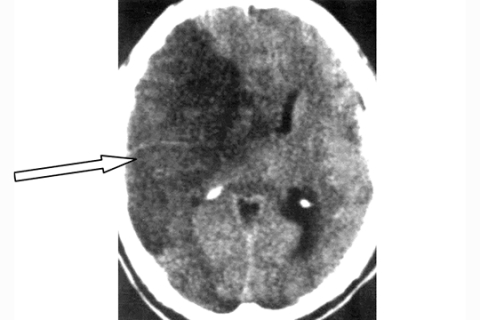 Рисунок 2б. КТ головного мозга этого же больного спустя 48 часов от дебюта инсульта (обширный гиподенсный очаг со смещением срединных структур, свидетельствующий об ишемическом типе инсульта)