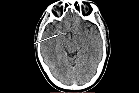 Рисунок 3а. КТ головного мозга больного ишемическим инсультом в острейшем периоде инсульта. Стрелкой указана гиперденсивная правая средняя мозговая артерия