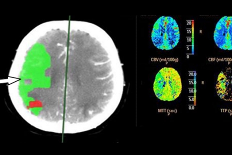Рисунок 5а. Перфузионная КТ головного мозга больного в острейшем периоде ишемического инсульта (до тромболизиса). Стрелкой указана зона пенубры