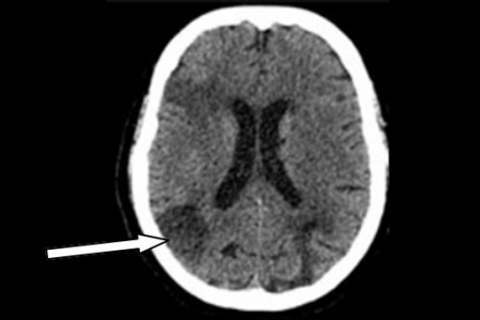 Рисунок 5б. Нативная КТ головного мозга у больного ишемическим инсультом спустя 24 часа после тромболитической терапии
