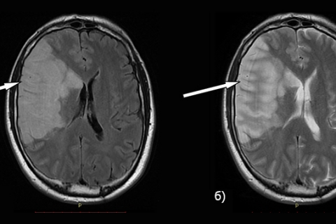 Рисунок 6. МРТ головного мозга в T2 Flair (а) и Т2 (б) режимах у больного ишемическим инсультом на 3 сутки после дебюта инсульта. Стрелкой указана обширная зона ишемических изменений в правой височно-лобно-теменной области, в головке хвостатого ядра, внутренней капсуле справа с деформацией правого бокового желудочка, смещение серединных структур на 6 мм