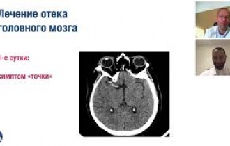 Отек головного мозга (в рамках конференции 25 августа 2020, Узбекистан).