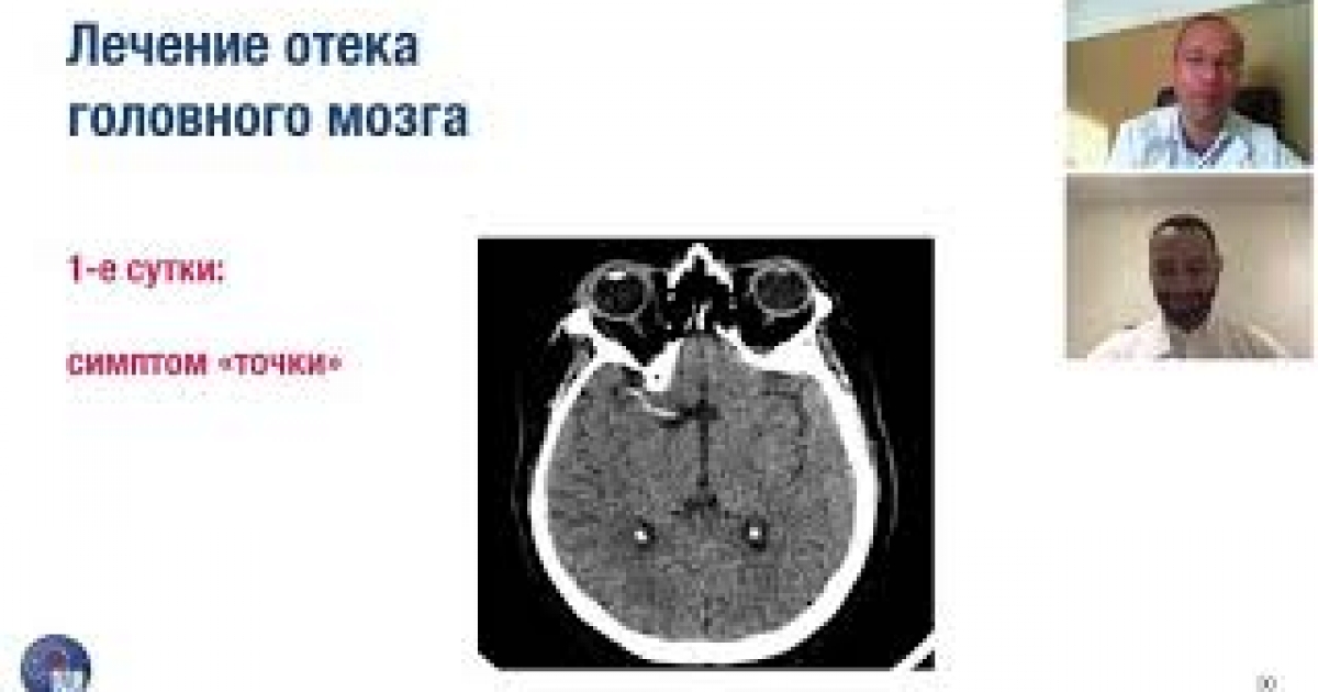 Отек головного мозга признаки. Отек головного мозга Горячев. Травматический отек головного мозга. Высотный отек головного мозга.