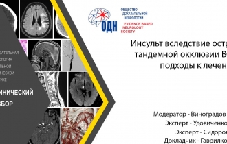 Инсульт вследствие острой тандемной окклюзии ВСА: подходы к лечению.